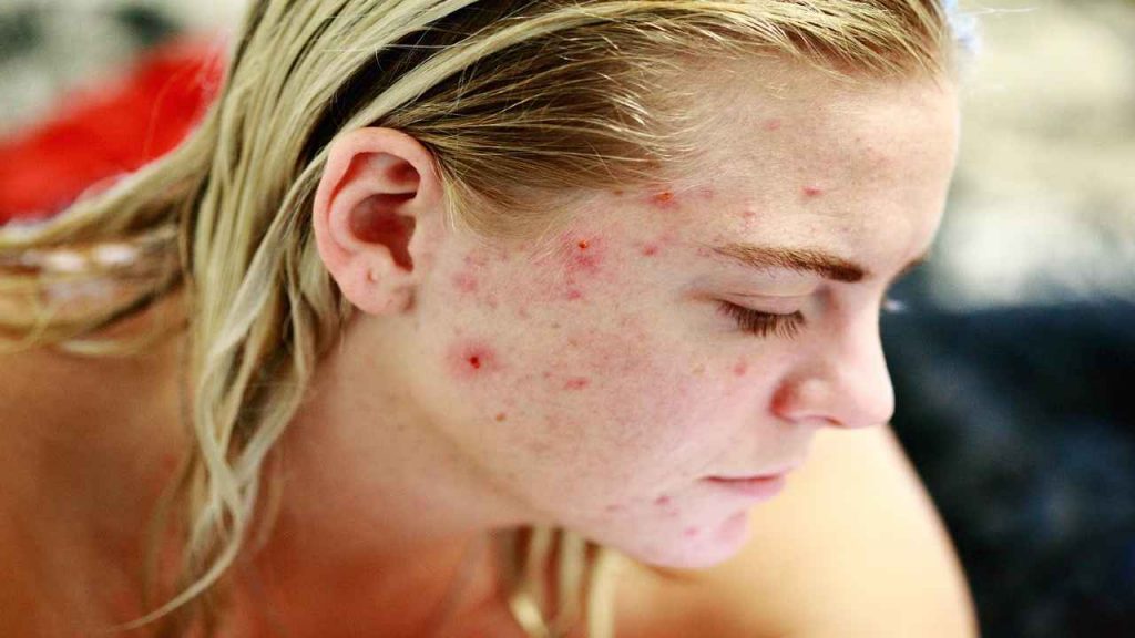 Combattere l'acne