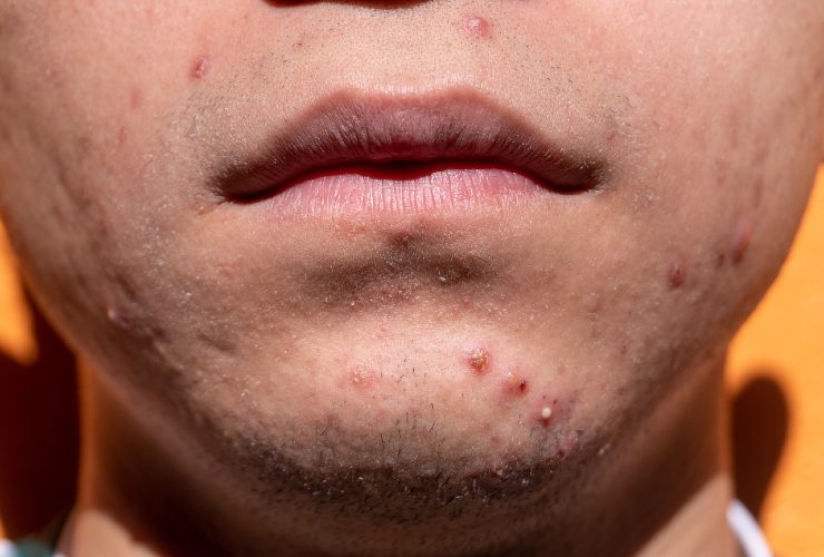 Combattere l'acne